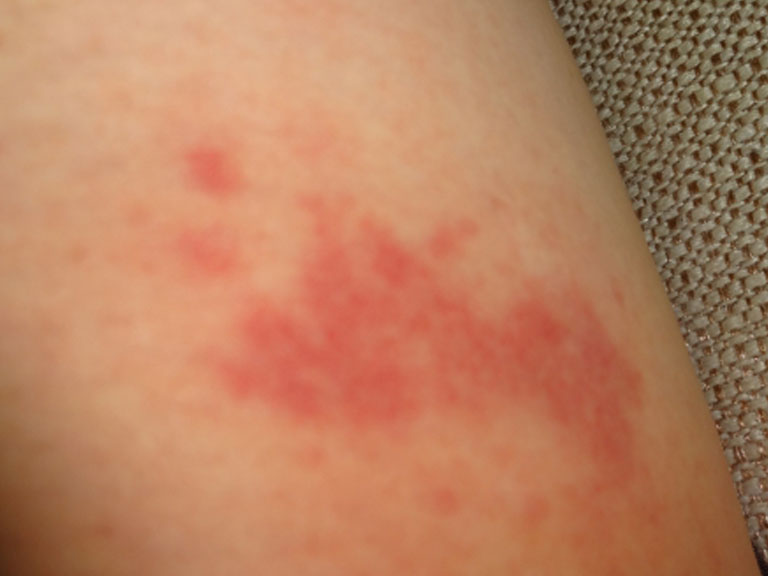 保険が使えるあざ治療｜六本木のクリアスキンクリニック西麻布