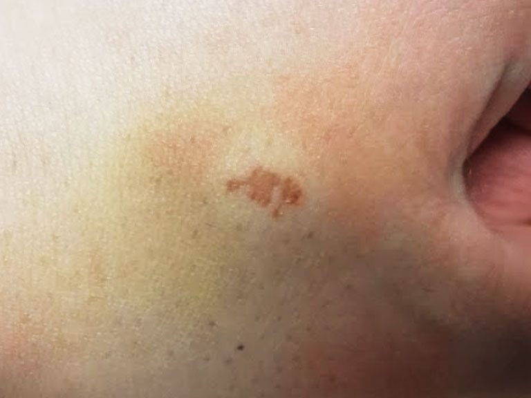 火傷・傷跡・手術跡を目立たなくする治療｜六本木のクリアスキンクリニック西麻布