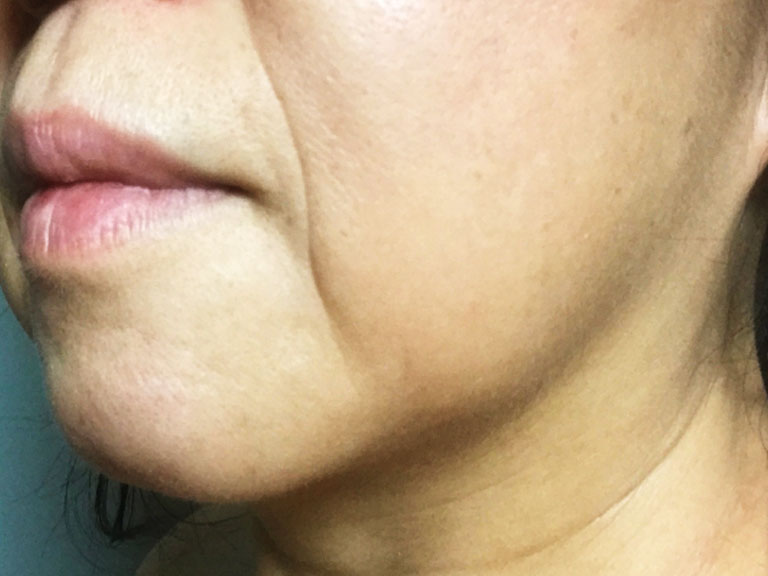 たるみ・シワ｜六本木のクリアスキンクリニック西麻布